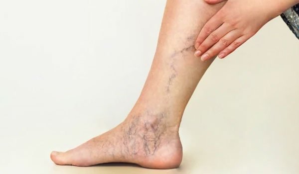 Varicose Veins